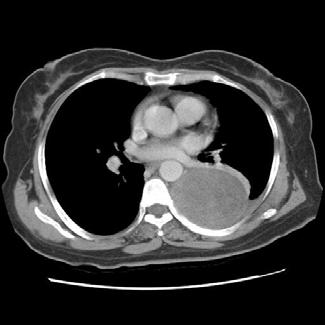 JH Cho et al: Two cases of benign solitary schwannoma with pleural effusion A B Figure 2. (A) Chest CT scan after drainage shows rounded huge mass in left paravertebral region.