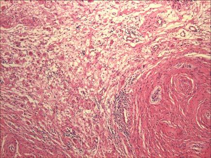 Hypocellular zones have microcystic change and inflammatory cell infiltrations (H&E stain, 100). 진찰소견 : 좌측흉부의호흡음이감소되어있었으며, 생명징후는혈압 130/80 mmhg, 체온 36.7, 맥박수는분당 94회였고, 호흡수는분당 24회이었다.