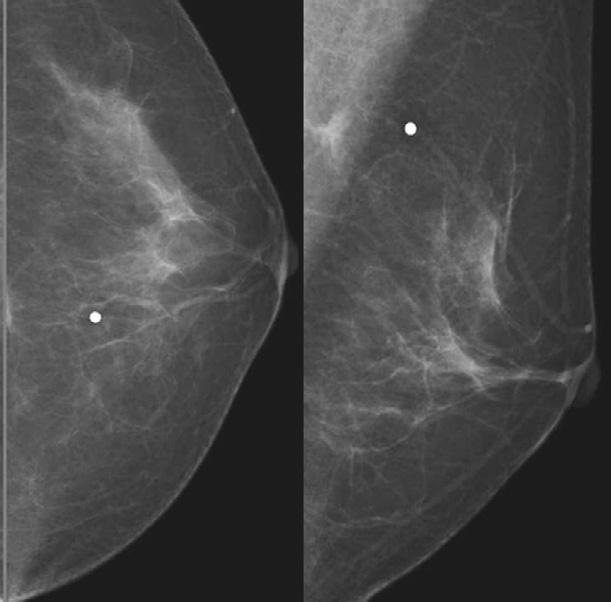 Imaging Findings of Missed reast Cancer Figure 1. n interval cancer (marked by marker) developing 11 months after previous screening mammogram reported as negative.