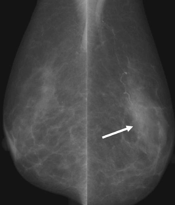 Imaging Findings of Missed reast Cancer C D Figure 4.