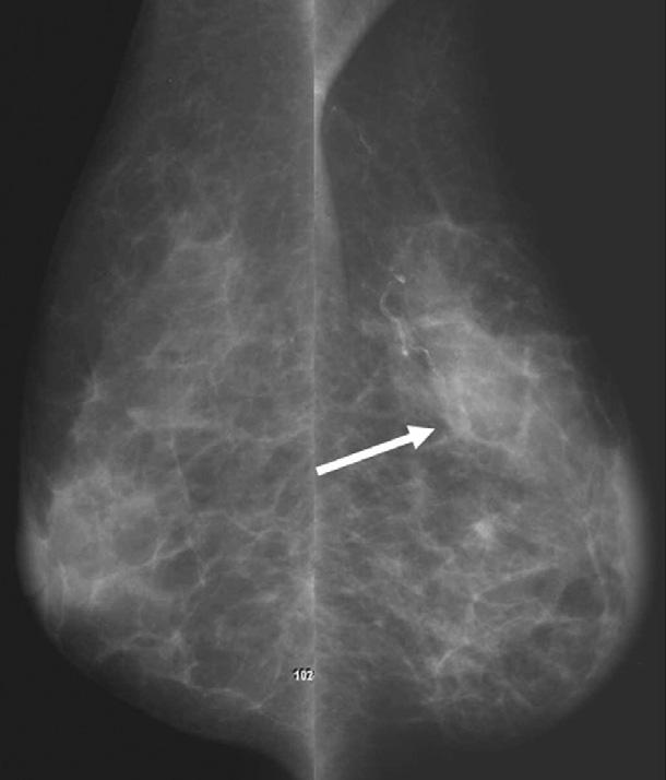 Follow-up MLO (C) and craniocaudal (D) mammograms obtained 7 months