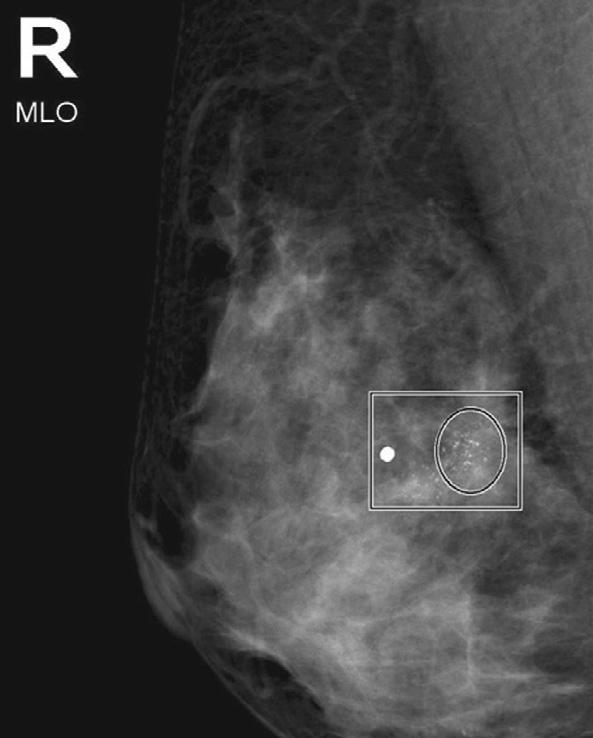 Han K Figure 5. mammogram marked by computer-aided detection program.