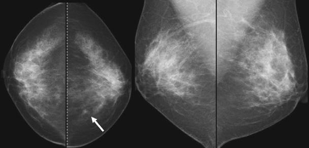 Imaging Findings of Missed reast Cancer Figure 6.