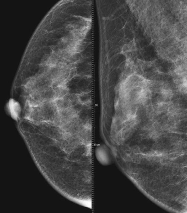 mastectomy show no apparent abnormality.