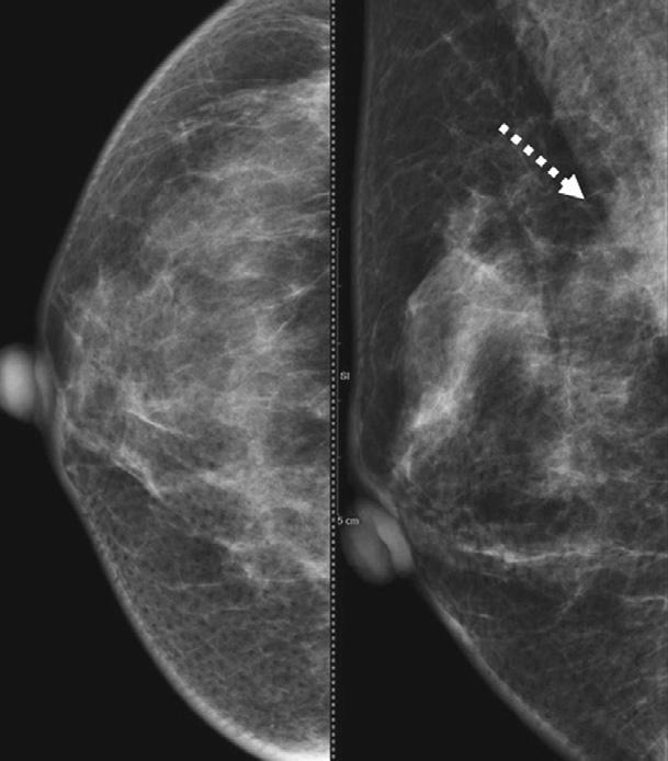 (D), a retrospective evaluation of mammograms () showed a
