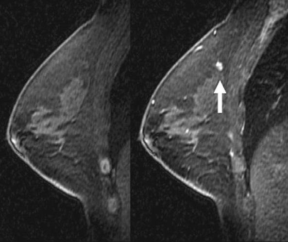 Imaging Findings of Missed reast Cancer Figure 10. lternative imaging-detected cancer.