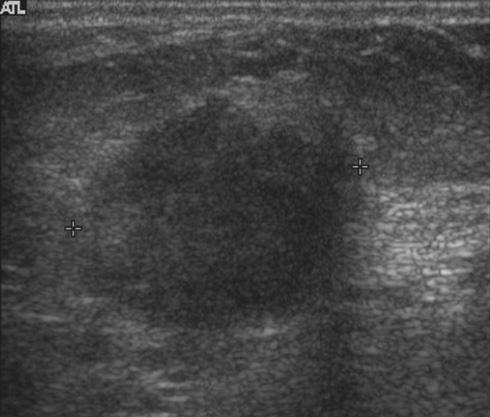 captured sonogram of right upper outer quadrant (; left) show normal fibroglandular tissue