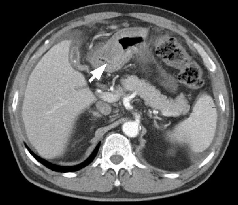 Fig. 1. Endoscopic and abdominal CT finding.