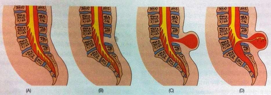 3-2) 신경관장애 ⑶ 이분척추 그림 13-10> 척수이상의분류 (A) 정상척수 (B) 잠재성이분척추 (C) 수막류 (D) 척수수막류 잠재성이분척추 수막류 척수수막류 척추후방판융합결핍, 결함부위는지방종,