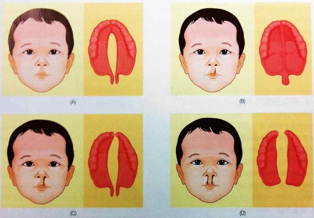 2-3) 토순과구개열 그림 13-2> 토순과구개열의유형 (A) 구개열만단독으로있는경우 (B) 입술의절흔이일측성이로있는경우 (C)
