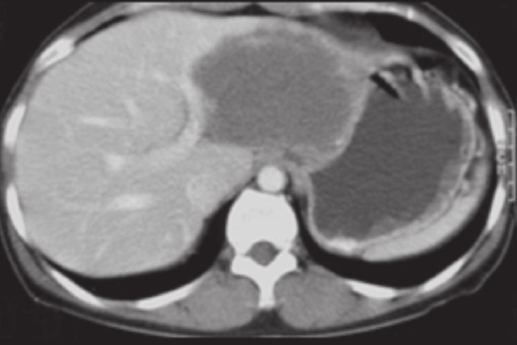 t Dong- University Hospital, the liver showed an 8 cm sized ill-defined mass with 1.