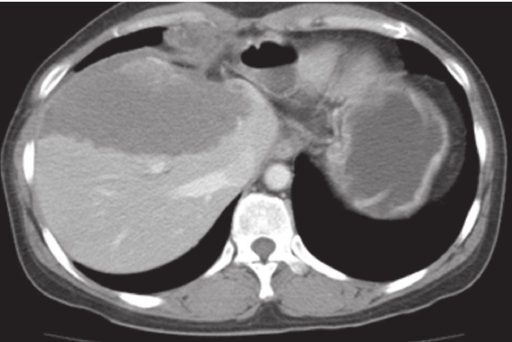 1, ) and no or poor enhancement after contrast injection. These radiologic findings suggested an inconclusive hepatic tumor with necrosis.