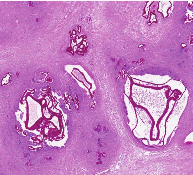 The cysts contained ribbon-like eosinophilic laminated layers, characteristic for E. multilocularis [4], which appeared more strongly red by periodic acid-schiff (PS) stain (Fig. 4).