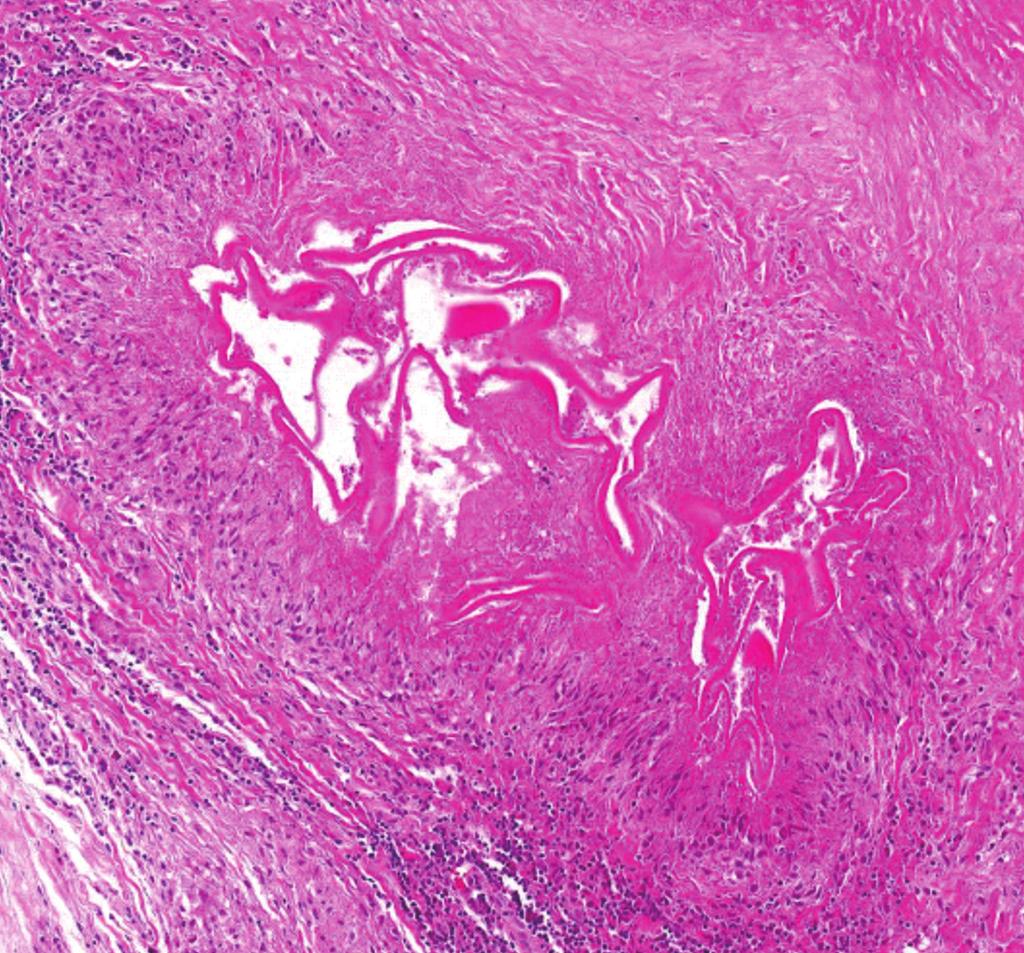 Kim et al.: case of recurrent hepatic alveolar echinococcosis 417 Fig. 5. Microscopic findings of the periphery of the liver mass (, H-E stain;, PS stain).