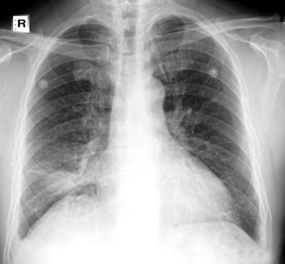 DH Noh et al: Two cases of chemical pneumonitis by hydrocarbon 을보였다 (Figure 2). 증례 2 환자 : 김, 남자, 60 세 Figure 2.