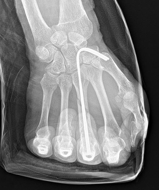 (A, B) Pre-operative true antero-posterior and oblique radiograph of the involved left hand of 80-year-old man with comminuted 3rd metacarpal shaft