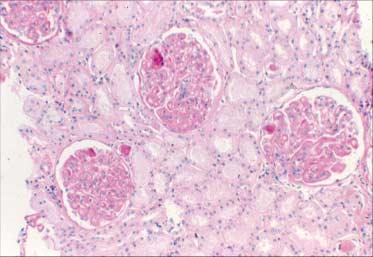 and tuft adhesion (PAS). (D) Lupus nephritis, class IV-G (A/C).