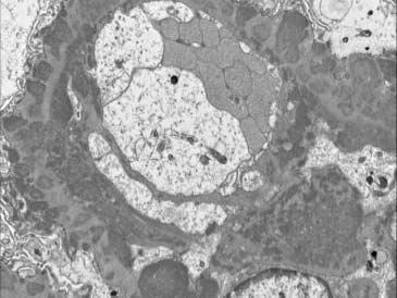 172 박문향 A B C D Fig. 7. Lupus nephritis class V. (A) Membranous lupus nephritis shows thickened glomerular capillary wall with subepithelial fuchsinophilic deposits (Masson s trichrome).