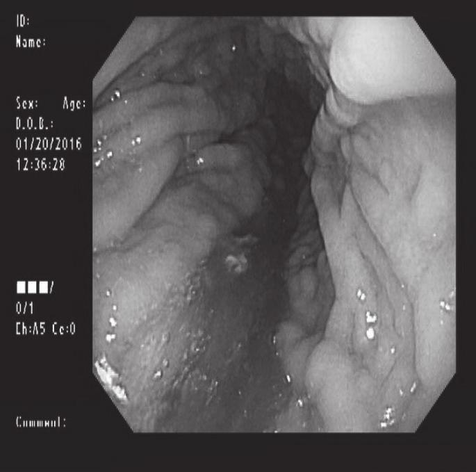 1 1 cm 크기의뇌하수체거대선종이관찰되었고, 종양내부중앙에낭성부위가보였다.