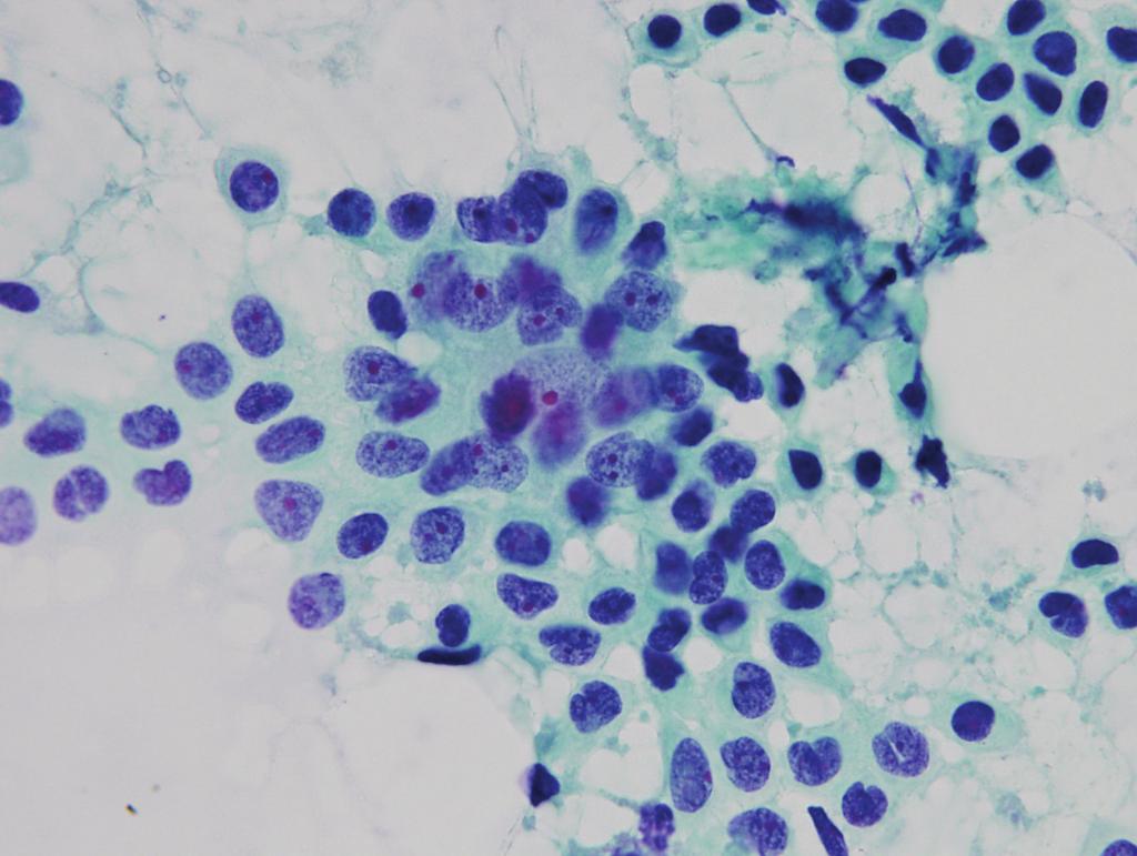 김지연 : 유방 악성 병변의 세포 소견 A B C D Fig. 2. Ductal carcinoma. (A&B) The malignant cells show coarse chromatin and large, abnormal shaped nucleoli. (Papanicolaou).