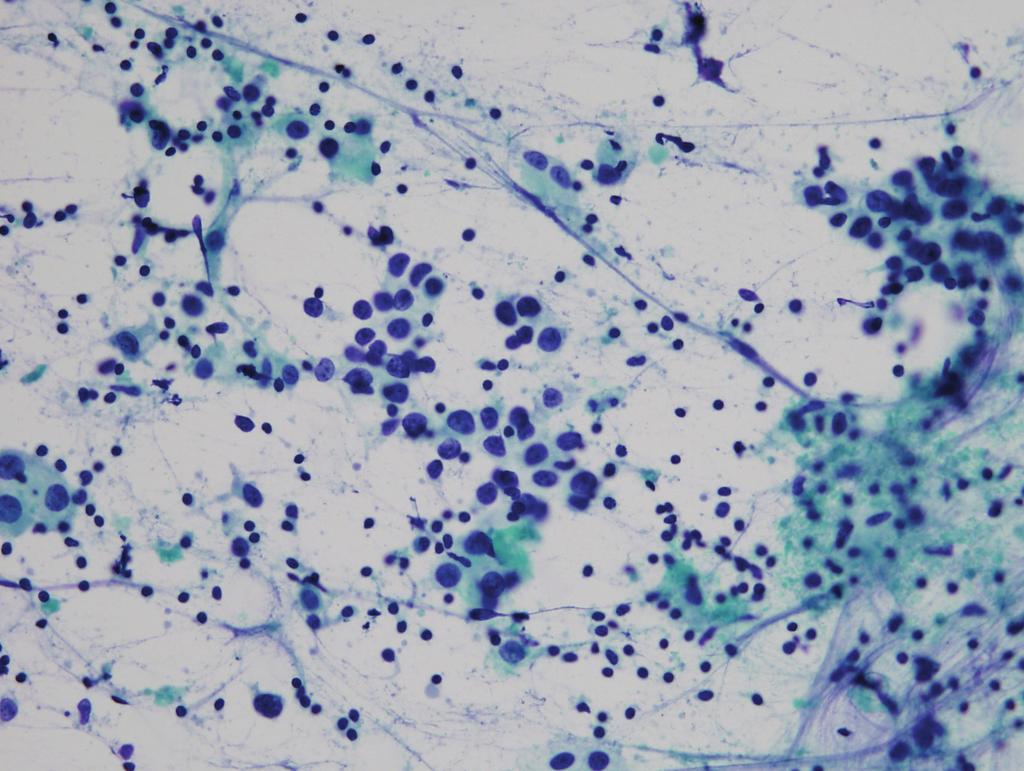 김지연 : 유방 악성 병변의 세포 소견 A B Fig. 4. Medullary carcinoma. (A) Large tumor cells with pale cytoplasm are surrounded by lymphocytes. (Papanicolaou).