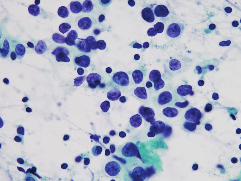 수질상 암종은 특유의 세포학적 특징 거친 과립상이고, 핵의 크기가 44um2 이상이고 세포의 크 으로 인해 악성으로 진단하기에는 어려움이 없지만, 확진 기가 82um2 이상이면 관세포 암종을 시사하는 소견이라는 은 조직검사에서 수질상 암종의 진단기준에 따라 이루어진 보고가 있다.22 즉, 개별세포가 많이 관찰되고, 세포의 크기 다.