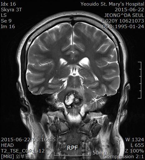 김수민 노현석 이찬솔 하유경 최동준 사상환자는교뇌부위의해면상혈관종이뇌교에위치한안면신경핵및안면신경경로에영향을미쳐안면신경마비가발생한것으로사료된다 (Fig. 4). Fig. 4. Brain magnetic resonance imaging pictures of the case.