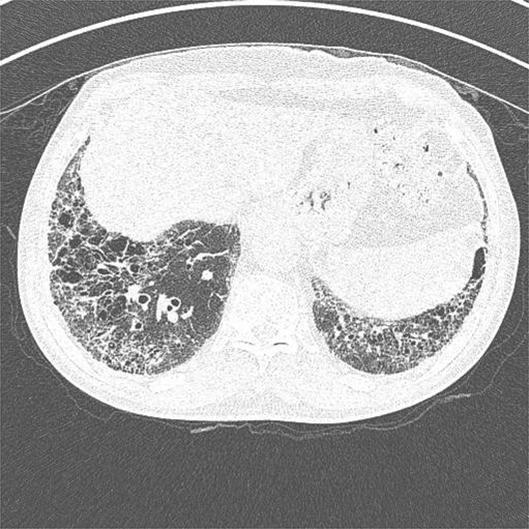 Chest radiography and computed tomography findings.