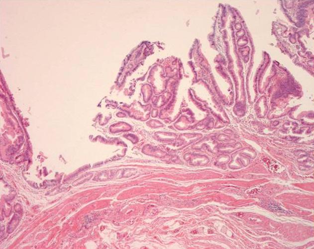 (H&E stain, 400). (C) The epithelium has a papillary architecture (H&E stain, 40).