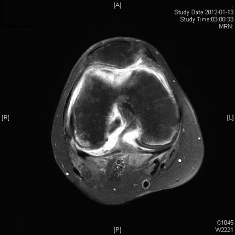 - 이슬기외 6 인. 전신경화증, 류마티스관절염의중복증후군 - A B Figure 2. Magnetic resonance image of the right knee shows diffuse synovial enhancement. (A) T1-weighted contrast-enhanced fat-suppressed axial image.