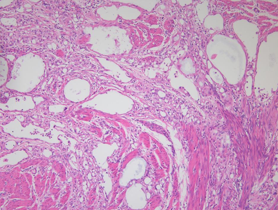 0) Hydrosalpinx 3 (1.6) All of the associated pathologies were recorded together. Fig. 1. Solid cords or variable sized cystic spaces lined by flat to cuboidal tumor cells (H&E stain, 100).