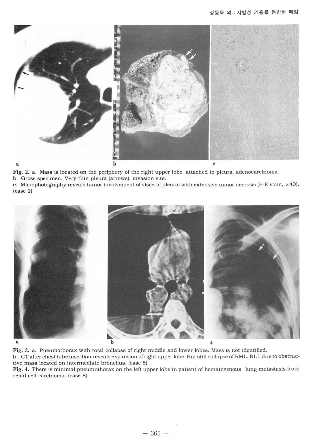 성동욱외 자발성기흉을동반한폐암 톰 F a b c Fig. 2. a. Mass is located on the periphery of the right upper lobe, attached to pleura, adenocarcinoma. b. Gross specimen. Very thin pleura (arrowsj, invasion site c.