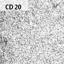 The immunophenotype of the tumor cells was positive for CD3, CD56, granzyme B, but negative for CD20. 혈소판 188,000/mm 3, 백혈구 6,230/mm 3 ( 중성백혈구 : 86.6%, 림프구 : 5.
