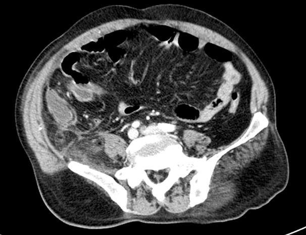 Tuberculosis and Respiratory Diseases Vol. 65. No. 3, Sep. 2008 Figure 1. Abdominal enhanced CT finding shows a distended appendix (1.4 cm) with wall thickening and fat infiltration around appendix.