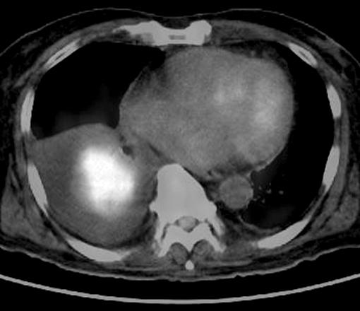 DW Shin et al: Appendiceal metastasis of small cell lung cancer Figure 3.