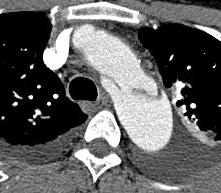 Tae-Hoon Kim, et al. Stent graft placement related retrograde stanford type A aortic dissection 4) 5) 6) 으로 보고되고 있다. Czermak 등, Lopera 등, Kato 등 은 용적률 39.