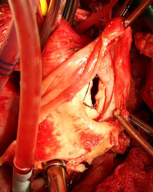 좌측대퇴동맥에는 8 Fr 혈관용피포를삽입한후 5 Fr pig-tail 도관 (Cook, Bloomington, IN, USA) 을병변보다근위부대동맥에위치시켰다.