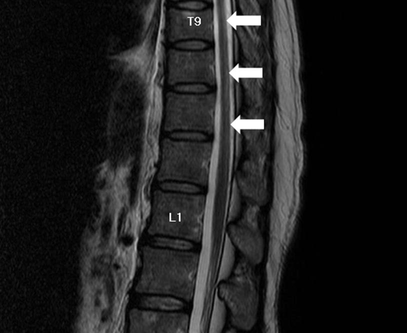 Pernicious Anemia in Rheumatoid Arthritis 1). 이에 시행한 전척추 자기공명영상(whole spine mag- 는 289 pg/ml로 정상 범위 내였다.
