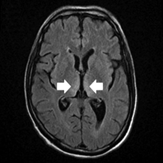 Cho KP, et al. Two Cases of Wernicke s Encephalopathy in Colon Cancer Patients 159 Fig. 1. Brain magnetic resonance images.