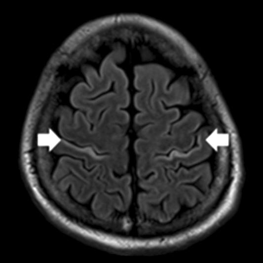 160 조경표등. 대장암환자에서발생한베르니케뇌병증 2 예 Fig. 2. Brain magnetic resonance images.
