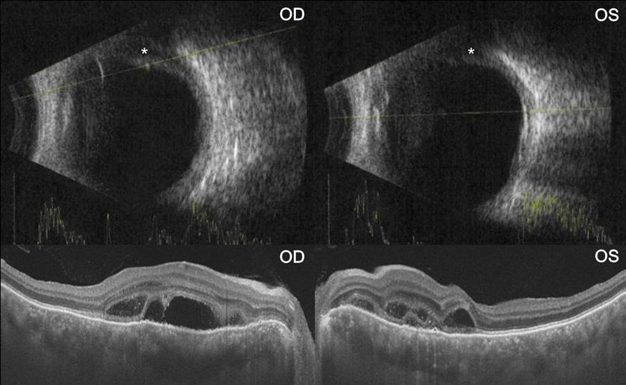 - 대한안과학회지 2018 년제 59 권제 10 호 - A B C D Figure 2. B-scan and optical coherence tomography images in both eyes.