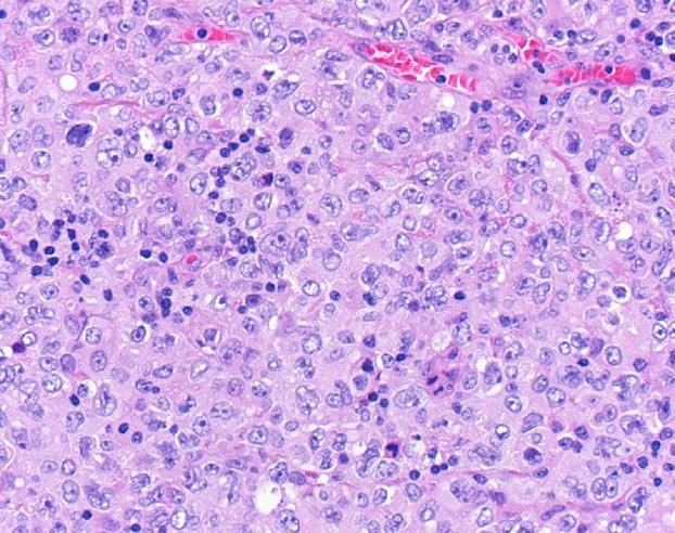 대흉외지 2007;40:435-440 Fig. 2. Microscopic finding of diffuse large B cell lymphoma (H&E stain, 400). Tumor cells show diffuse growth pattern.