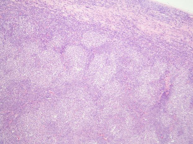 Microscopic finding of follicular lymphoma (H&E stain 200). Closely packed follicles are noted. The neoplastic follicles focally shows an almost back-to-back pattern.