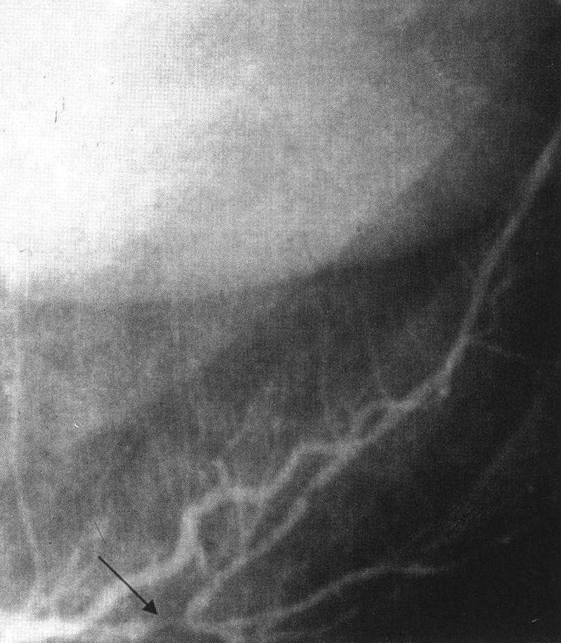 Fig. 3. The aneurysm of apical and anterolateral wall of the left ventricle was noted. The left ventriculogram of the diastole. The left ventriculogram of the systole.