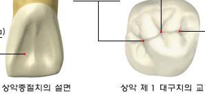 2) 와 (Fossa) : 치아표면에있는원형이나삼각형형태의오목한부위 1 설면와 -