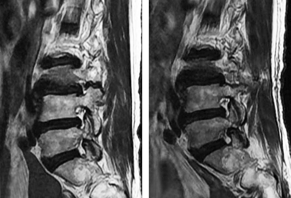 Journal of Korean Society of Spine Surgery Unilateral Biportal Endoscopy for Osteoporotic Vertebral Fracture A Fig. 5.