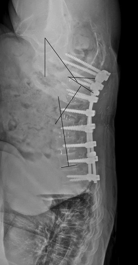 205 Recent Updates for Lateral Lumbar Interbody Fusion A B C D Figure 1.