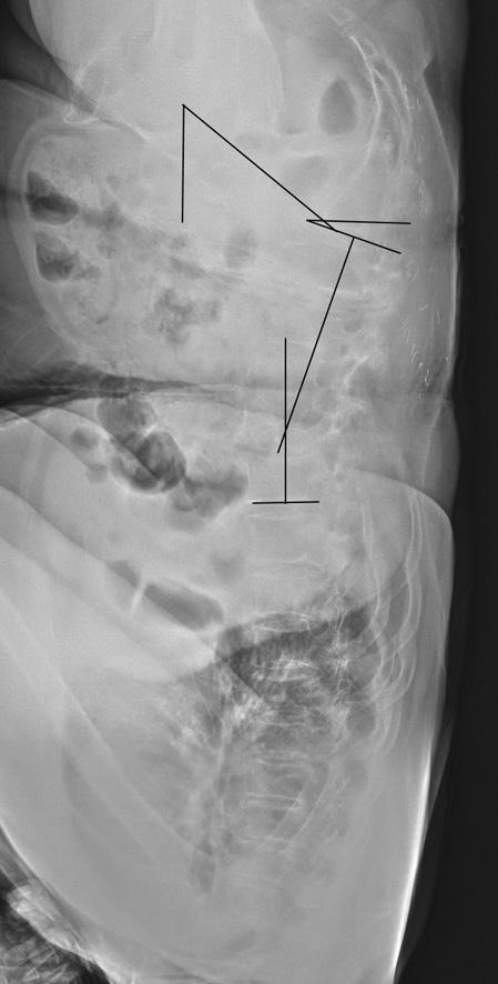 sagittal image shows widening of foramen due to restoration of disc height on L3 4 (arrow).