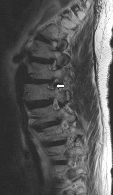 (D) After lateral lumbar interbody fusion and posterior percutaneous screw fixation, the T2-weighted MR