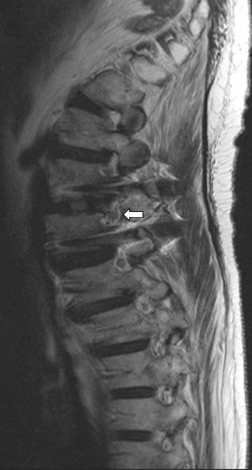scoliosis on lumbar spine was corrected.